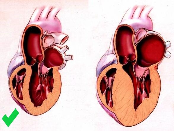 Cardione previne a hipertrofia ventricular do coração